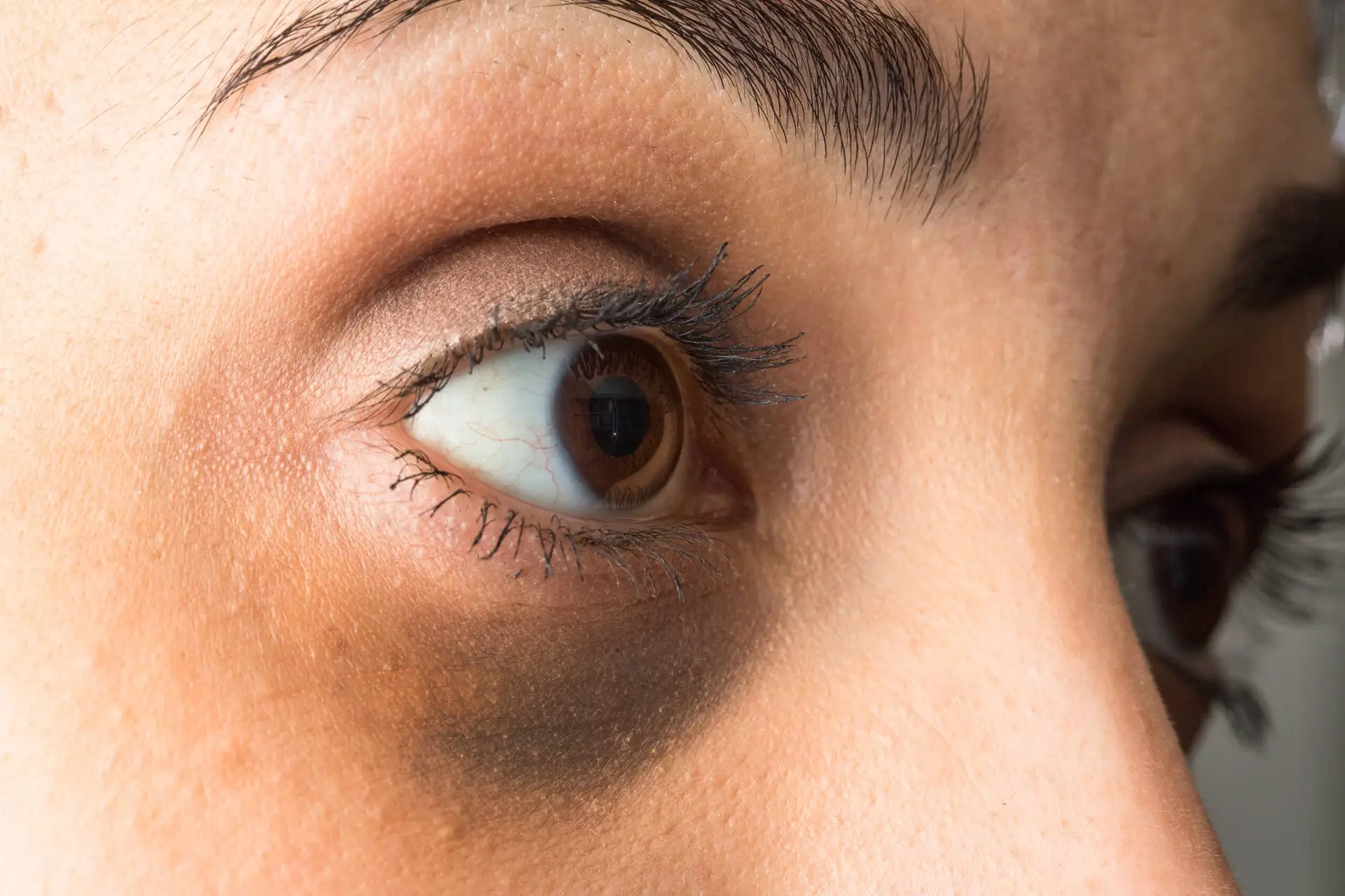 Close-up of under-eye dark circles showing periorbital hyperpigmentation